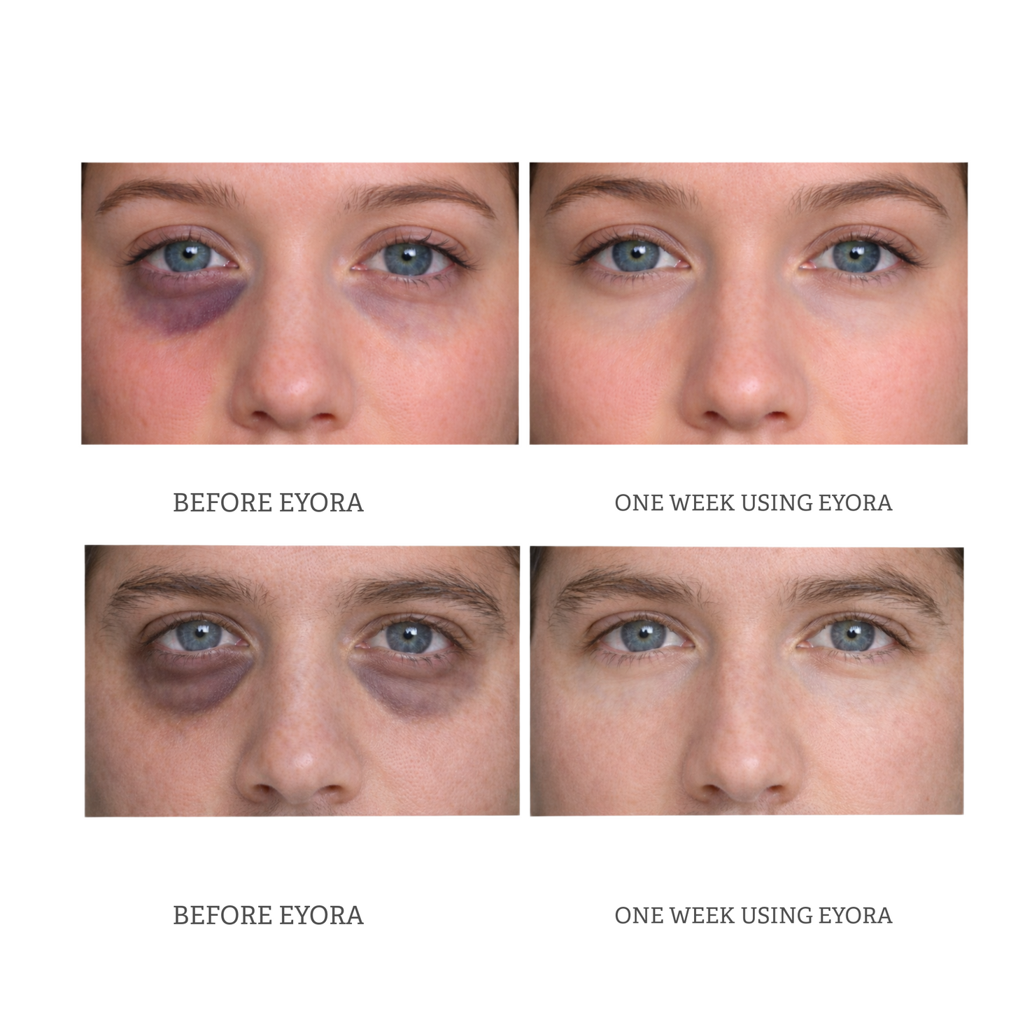 EYORA Ocular Recovery Massager | E1 Bio-Heat & Compression